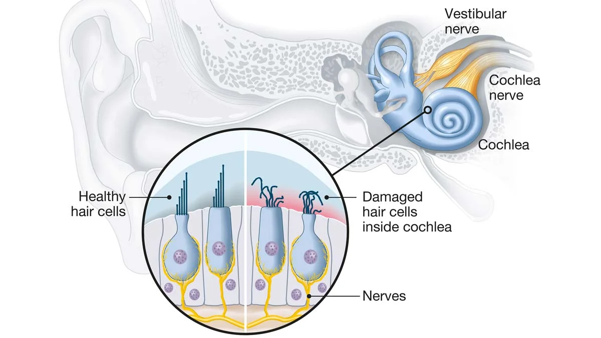 Sensorineural Hearing Loss: Causes, Symptoms & Treatment